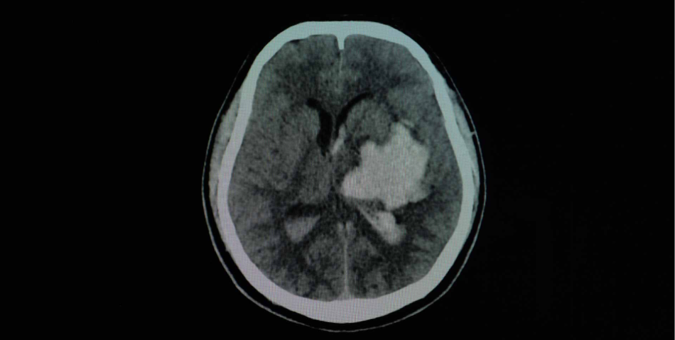 Cerebral Hemorrhage: Causes and Methods of Treatment.