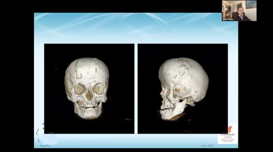 Inion Webinar: Dr. Dylan Murray – Pediatric Cranioplasty with the Inion CPS™ Bioabsorbable Implants