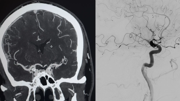 Improving the stroke pathway in southern Sweden