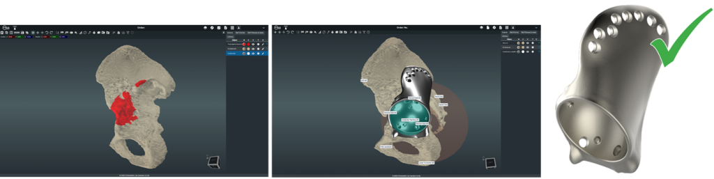 MICE, the Medical Implants AI-Driven 3D Customization Engine, is a cutting-edge, web-based 3D product design configuration and pre-surgical planning software. This innovative platform is specifically designed to facilitate the active involvement of surgeons in patient-specific implants and surgical guides ordering and design validation processes. As a groundbreaking tool, MICE aims to transform into the standard of communication between surgeons and manufacturers for pre-surgical planning in a 3D environment and for processing orders for patient-specific implants and surgical guides.