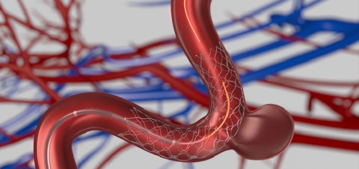 Neurovascular Thrombectomy Devices Market